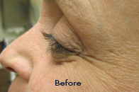 Skin Care Birmingham - Botox / Dysport  17