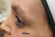 Skin Care Birmingham - Botox / Dysport  18