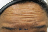 Skin Care Birmingham - Botox / Dysport  19