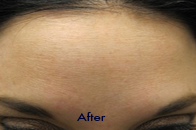 Skin Care Birmingham - Botox / Dysport  04