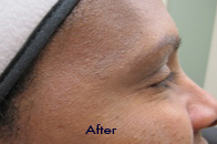 Skin Care Birmingham - Botox / Dysport  06