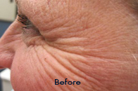 Skin Care Birmingham - Botox / Dysport  07