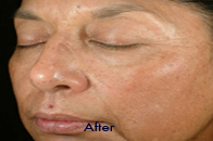 Skin Care Birmingham - Chemical Peel  02