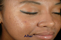 Skin Care Birmingham - Chemical Peel  04