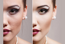 Dermal Filler Birmingham - Before Treatment