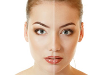 Dermal Filler Birmingham - After Treatment
