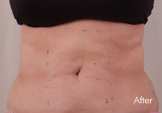 Laser Treatment Birmingham - After Exilis Treatment