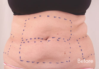 Laser Treatment Birmingham - Before Exilis Treatment
