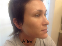 Fraxel Birmingham - After Fraxel Laser  Treatment 01