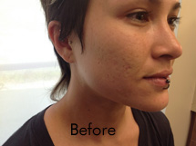 Fraxel Birmingham - Before Fraxel Laser  Treatment 01 