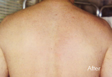 Laser Hair Removal Birmingham - Laser Hair Removal after Treatment