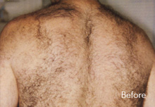 Laser Hair Removal Birmingham - Laser Hair Removal before Treatment