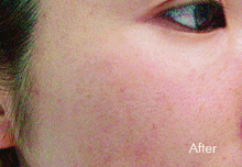 Laser Treatment Birmingham - After Laser Treatment