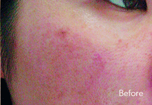 Laser Treatment Birmingham - Before Laser  Treatment