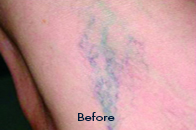 Skin Care Birmingham - Laser Treatment  01