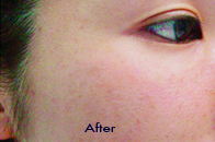 Skin Care Birmingham - Laser Treatment  10
