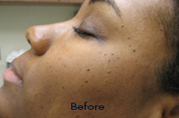 Skin Care Birmingham - Laser Treatment  11