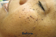 Skin Care Birmingham - Laser Treatment  13