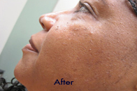 Skin Care Birmingham - Laser Treatment  14