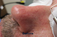 Skin Care Birmingham - Laser Treatment  15