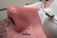 Skin Care Birmingham - Laser Treatment  16
