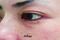 Skin Care Birmingham - Laser Treatment  04