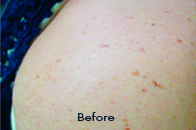 Skin Care Birmingham - Laser Treatment  05