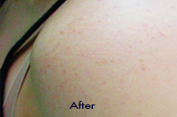 Skin Care Birmingham - Laser Treatment  06