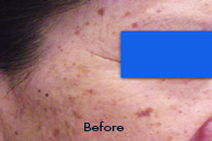 Skin Care Birmingham - Laser Treatment  07