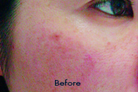 Skin Care Birmingham - Laser Treatment  09