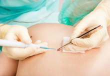 Mole Removal Birmingham -  Mole  Removal Before Treatment