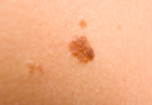 Mole Removal Birmingham  - Mole  Removal After Treatment