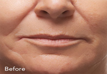 Radiesse Birmingham - Radisse  before Treatment 1