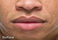Radiesse Birmingham - Radisse  Before Treatment 3 