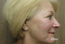 Sculptra Birmingham - Sculptra  after Treatment