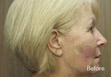 Sculptra Birmingham - Sculptra  before Treatment