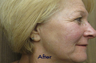 Skin Care Birmingham - Sculptra  02