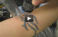 Laser Tattoo Removal Birmingham - Tattoo Removal  Video 2