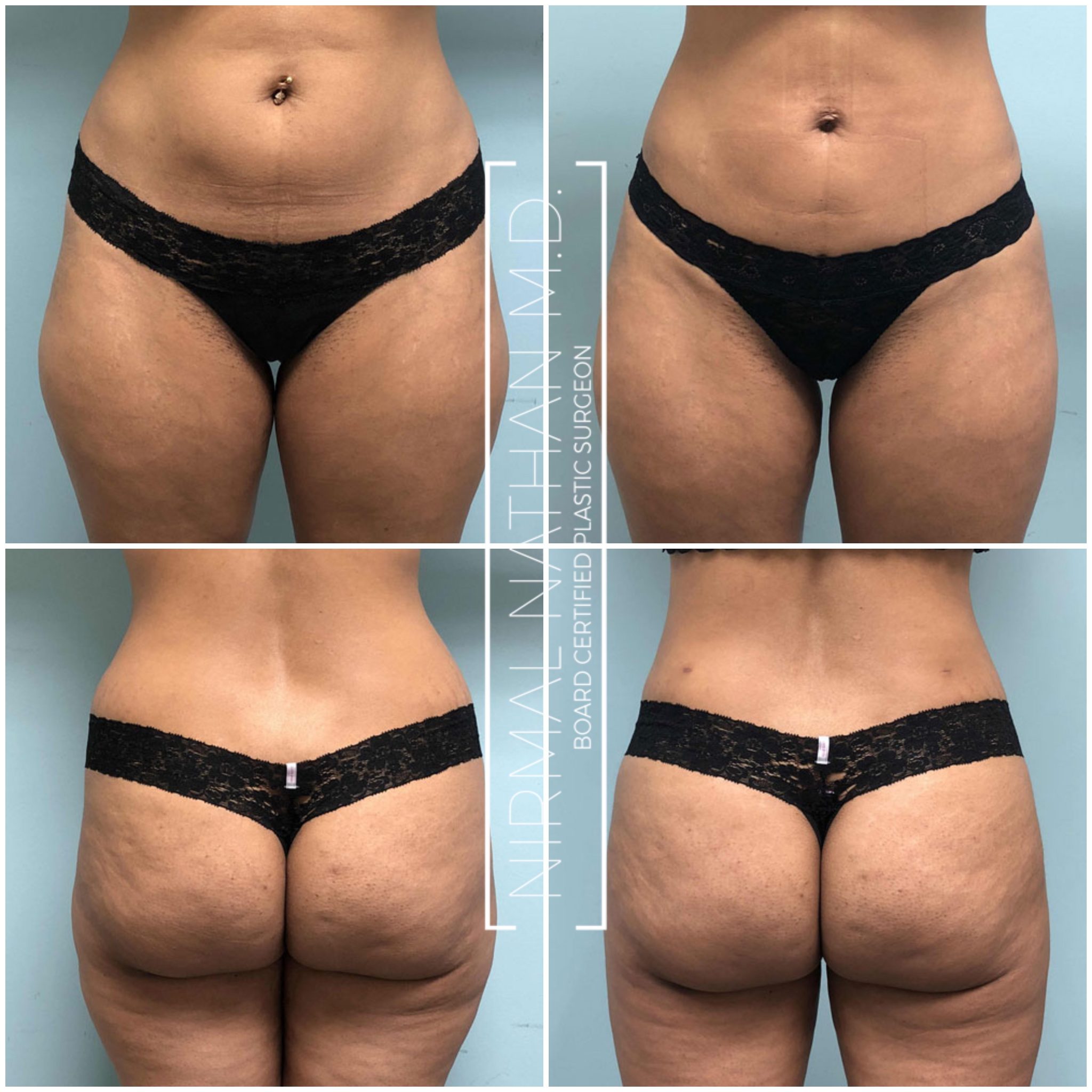 Dr Nathan sculpts away saddlebags and fat!