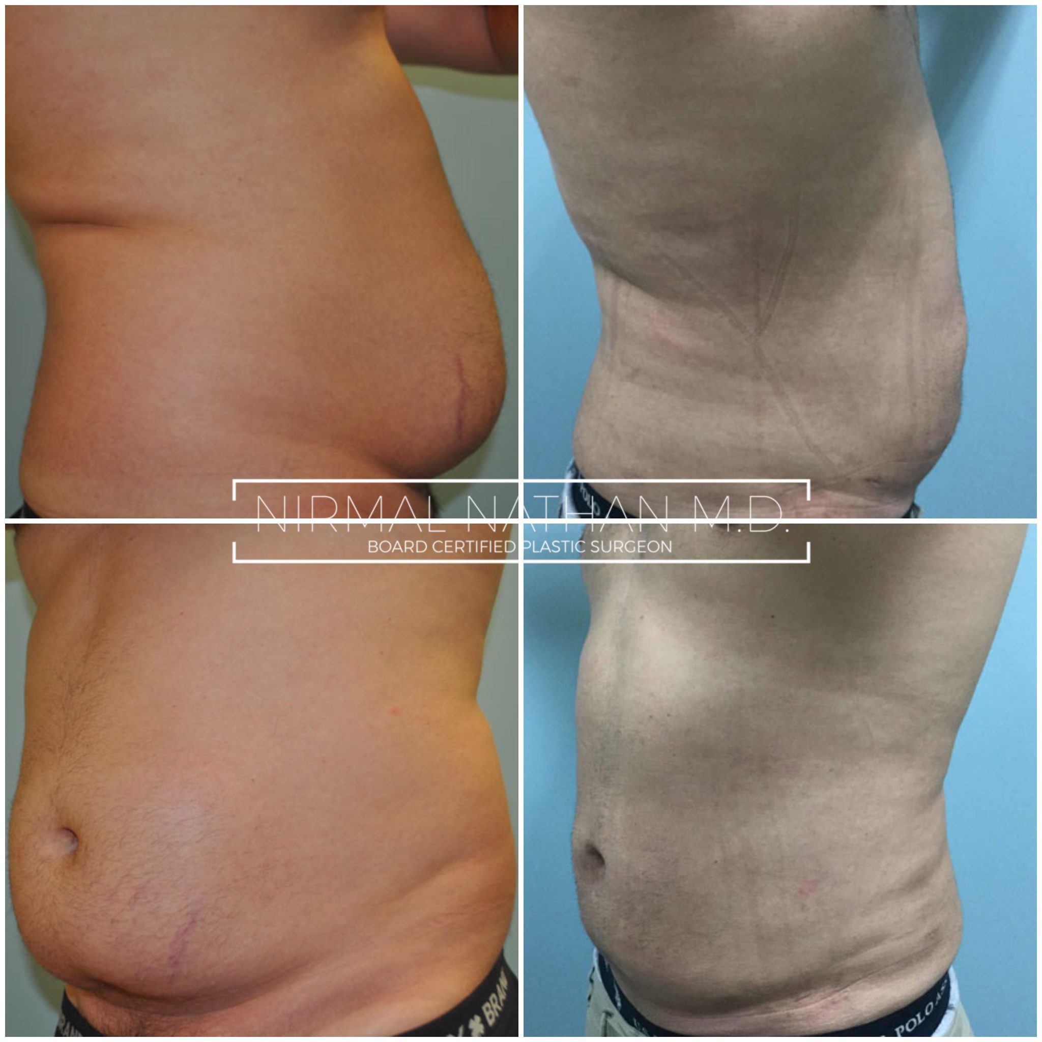 Dr Nathan Liposuctions Belly Fat