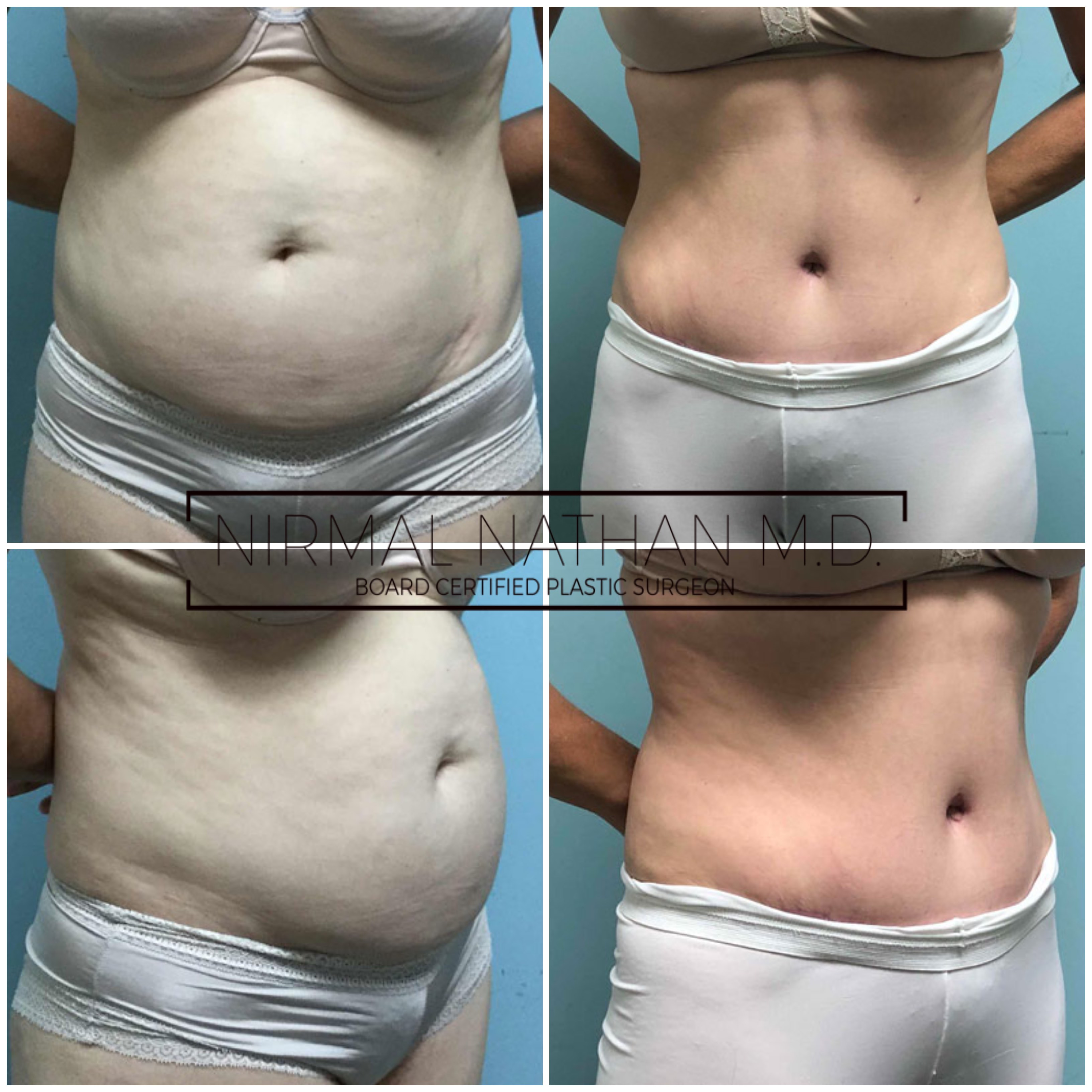 Dr Nathan Liposuctions Belly Fat