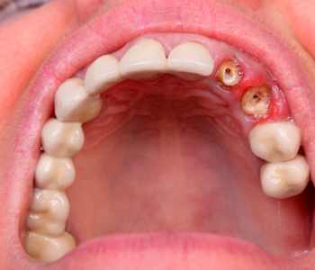 When seeking affordable care, it pays to consider the benefits of dental implants in Pickering