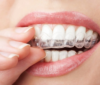 Avoid traditional braces with Invisalign treatment in Scarborough, ON