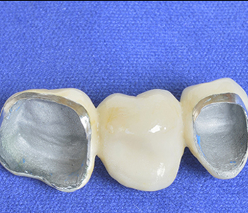 Porcelain dental crowns are a cost effective smile preserving treatment in Pickering