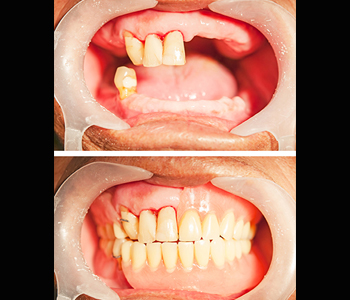 Various uses of dental crowns from your Scarborough dentist