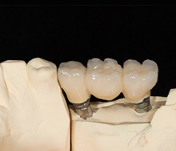 Dental restoration from your Scarborough dentist helps you feel great about your smile