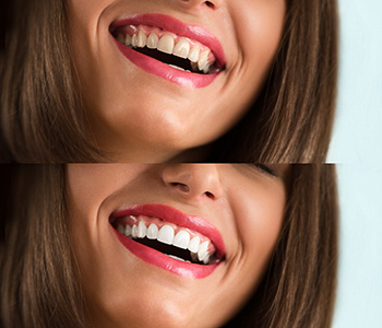 Your smile is not beyond repair! See what an experienced cosmetic dentist in Scarborough can do for you