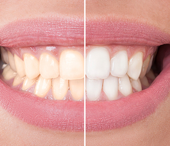 Identifying internal and external stains for teeth whitening near Pickering