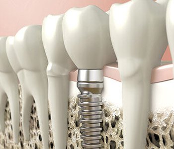 M1P 2S1 area dentist explains the advantages of placing dental implants