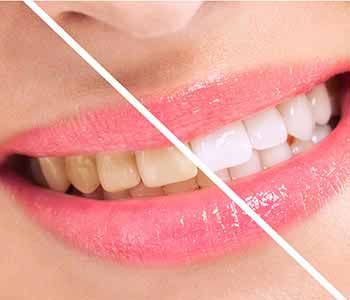 How to fix discolored teeth using professional whitening services from Scarborough dentist